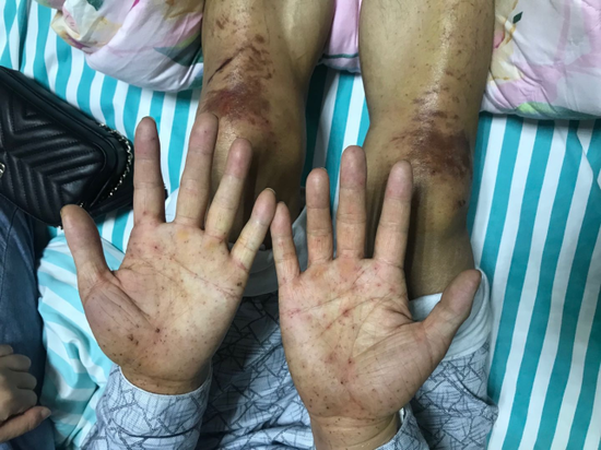 甘肃马拉松幸存选手怕失去意识用带刺的草扎自己双膝磨烂