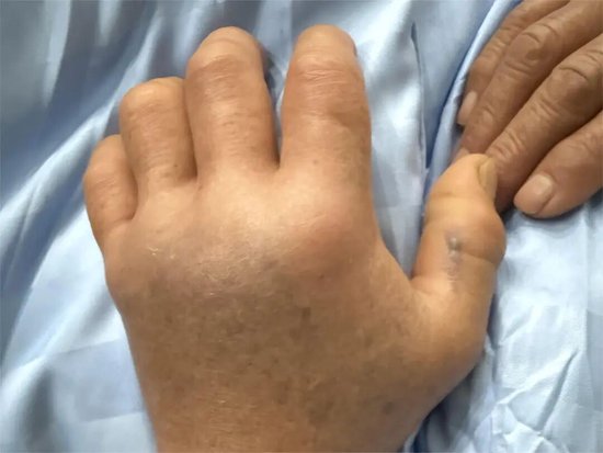 伤口发黑坏死，命悬一线！65岁大妈遭蛇偷袭，惊险全过程曝光
