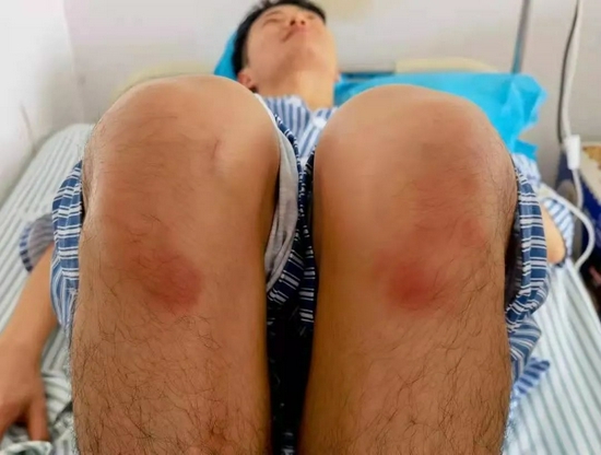 由于腰部受伤,李英豪被送往医院治疗。长时间跪地,李英豪膝盖出现大面积红肿。来源:受访者供图
