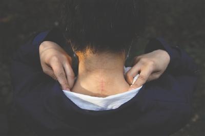 遭老虎咬伤的赵女士向记者展示颈部伤痕 图据新京报