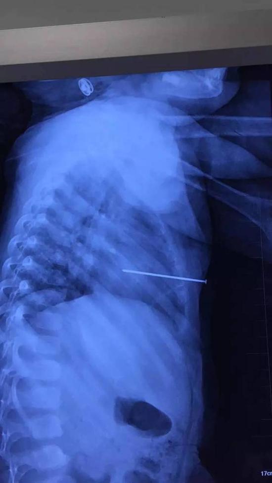 男童玩气钉枪朝自己开枪 5厘米钉子射中小心脏