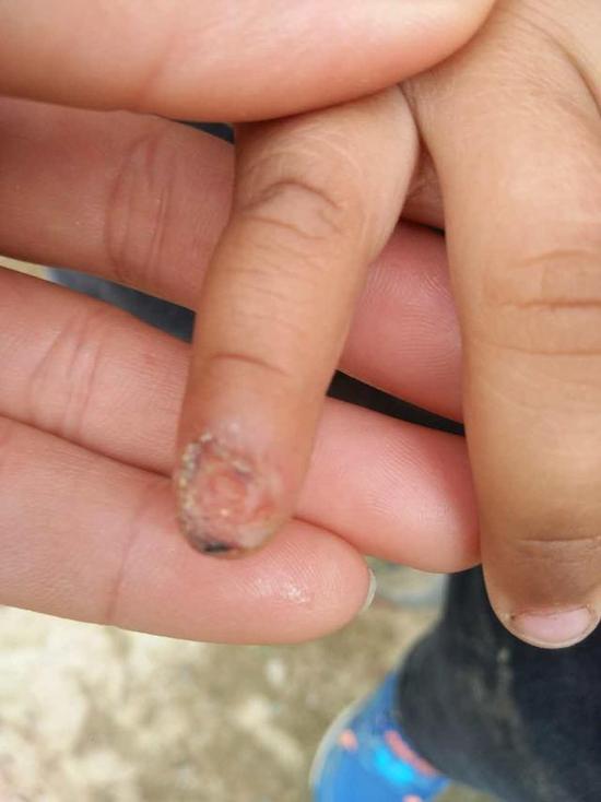 3岁男童幼儿园内手指甲脱落 园长:孩子自己撕的