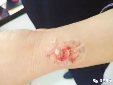 瘾君子盗窃电动三轮车被抓 疯狂自残咬伤民警