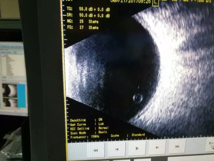 眼科b超检查中发现的眼球内虫幼体