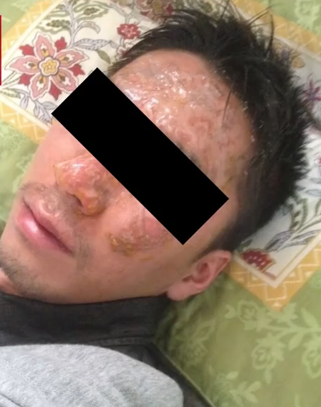 日社长把员工的脸按进火锅取乐 员工严重烫伤(图)