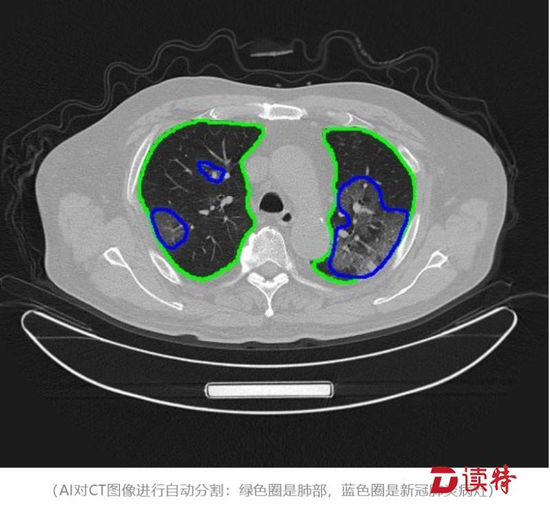 “腾讯觅影”AI辅助诊断