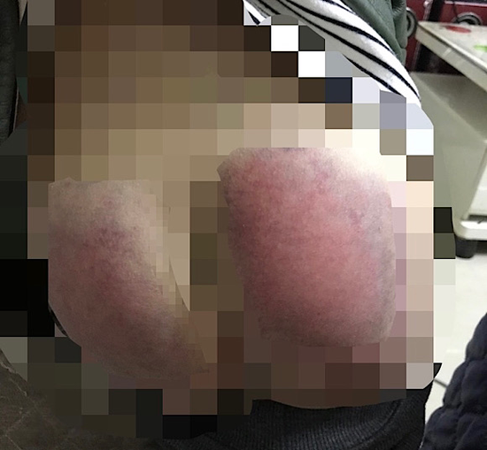 琪琪因没完成作业,双侧臀部被班主任用按摩板打得淤青。