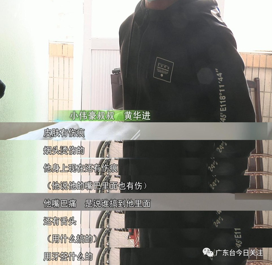 7岁男童满身烟头烫伤疤双手面临截肢 疑凶是亲生