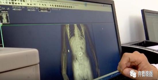 3岁男童肚子疼打针都无效 医生拍片发现异物(图