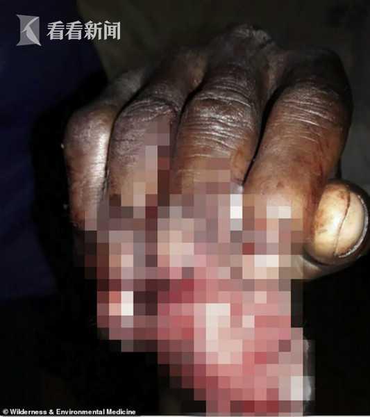 津巴布韦一男子遭鳄鱼袭击右腿 徒手掰嘴断指逃