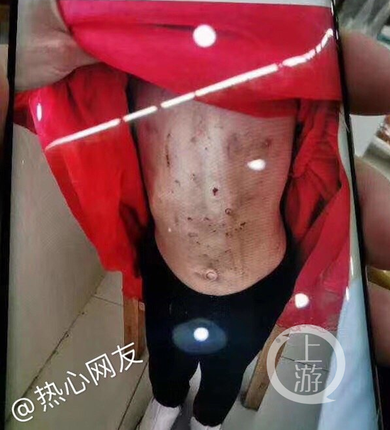 ▲4岁女童涵涵身上有多处伤痕,医院的护士判断女童伤势系人为。受访者供图