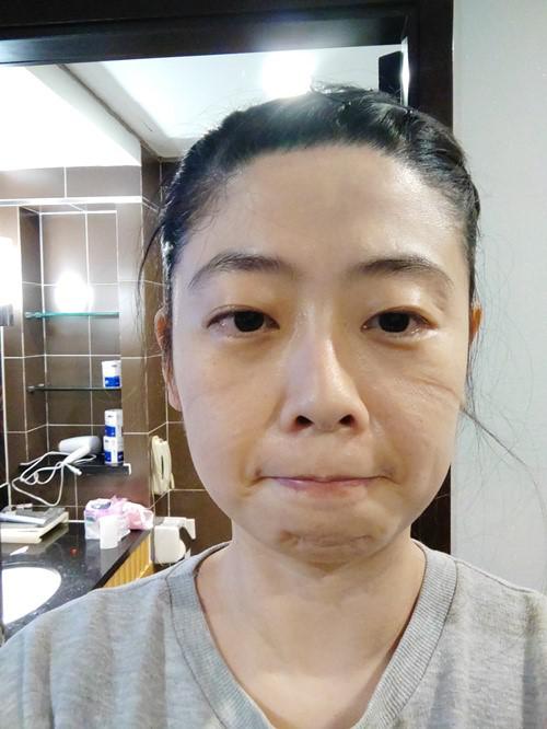 李蕊的臉頰被口罩壓出了勒痕。受訪者供圖