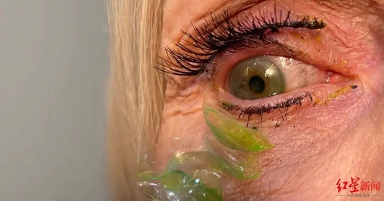 库尔特耶娃从病人眼中取出一大串隐形眼镜的瞬间