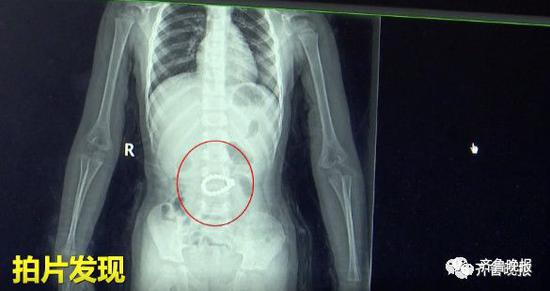 3岁男童肚子疼打针都无效 医生拍片发现异物(图
