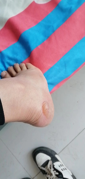 娟娟发现脚被磨出了水泡 图源受访者