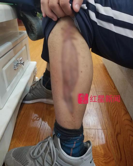 小凡腿上的伤疤(已作适度处理)