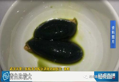 鱼胆明目?女子生吞鱼胆结果当晚肝衰竭住进医