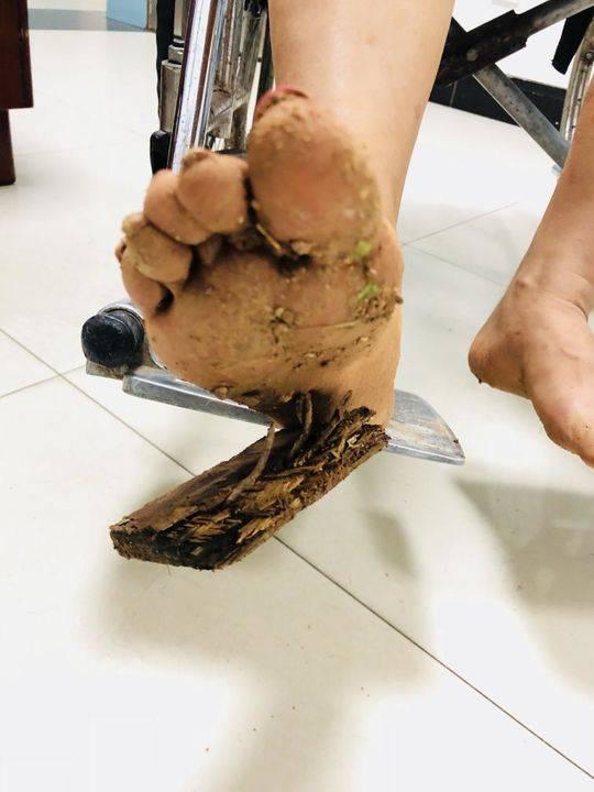 看着就疼 女子穿拖鞋晨跑脚底扎进铁钉板(图)