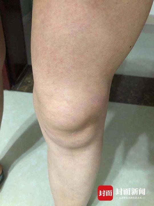 余女士称出现积液的膝盖。