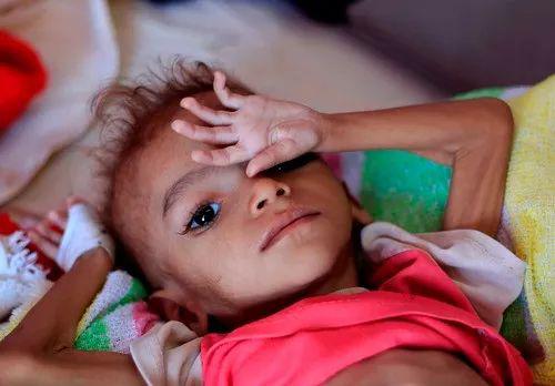 这是10月6日在也门萨那一个治疗中心拍摄的营养不良儿童。（新华社/法新）