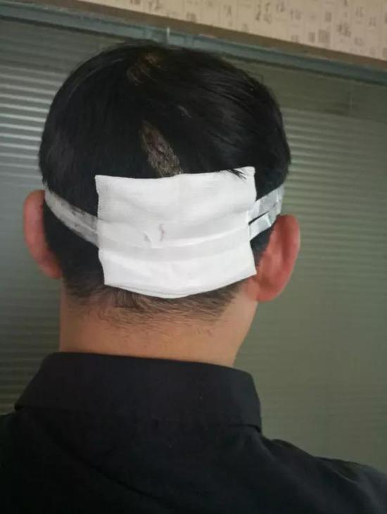 医院检查,后脑勺有道好深的伤口,缝了6针.