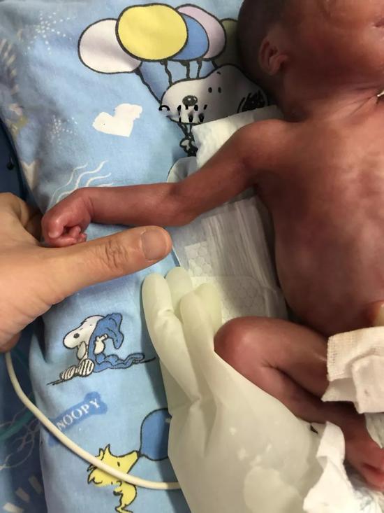宝宝的手臂只有成人拇指粗。图 | 民大医院