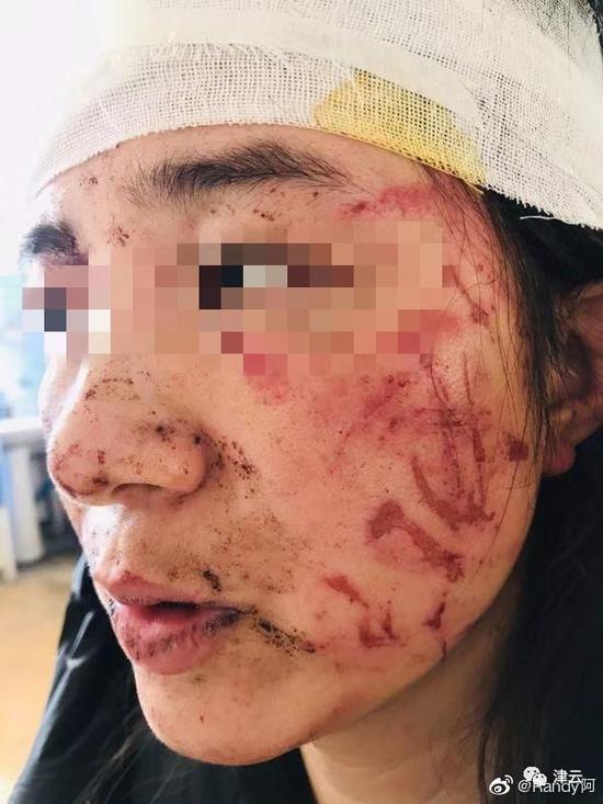  孙某受伤的脸