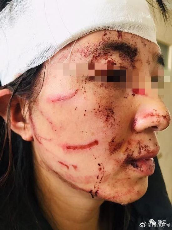 温州女子遭丈夫暴打塞粪 律师：如此侮辱该被公