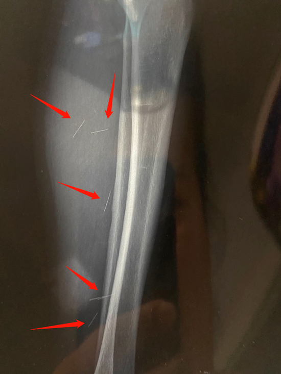 ct照片显示姜女士小腿内居然有六根断针!