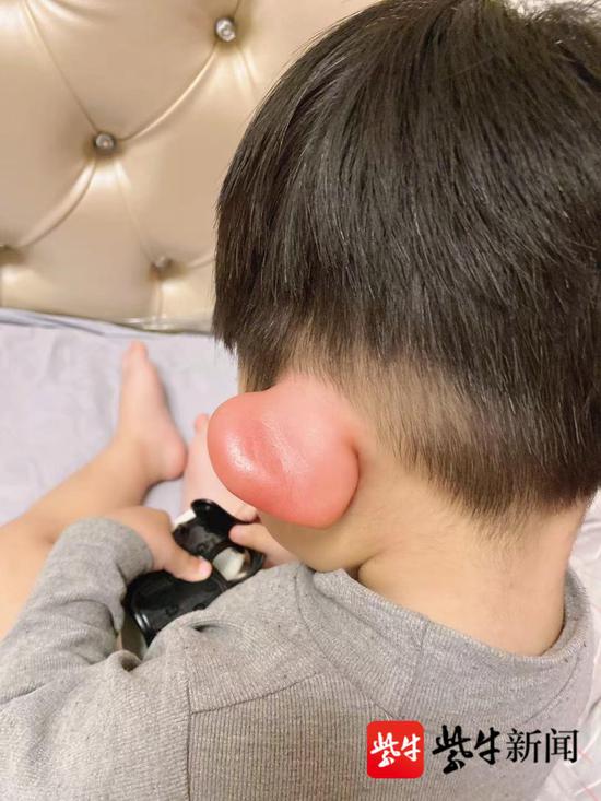 近日,陕西西安的一岁宝宝左耳被蚊虫叮咬后,红肿到右边耳朵的一倍,看