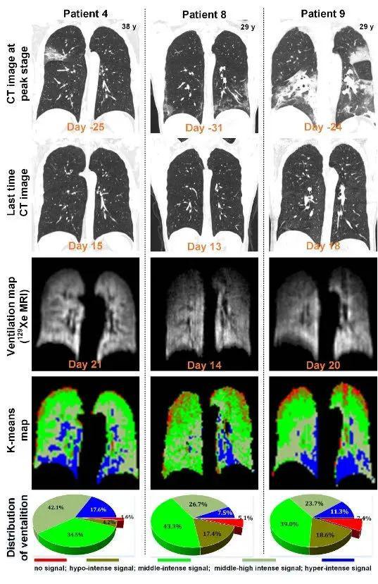  图2：三名新冠出院患者的典型肺部影像