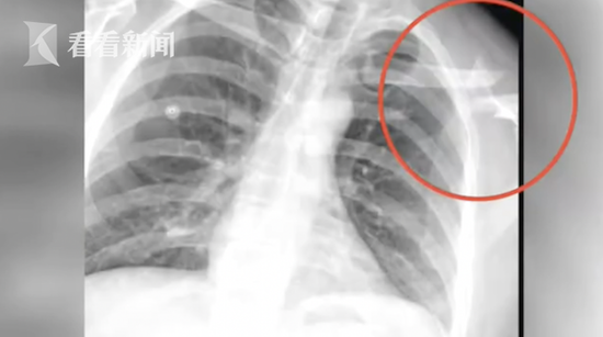 男子被260米风筝带上天摔骨折 索赔找不到人(图