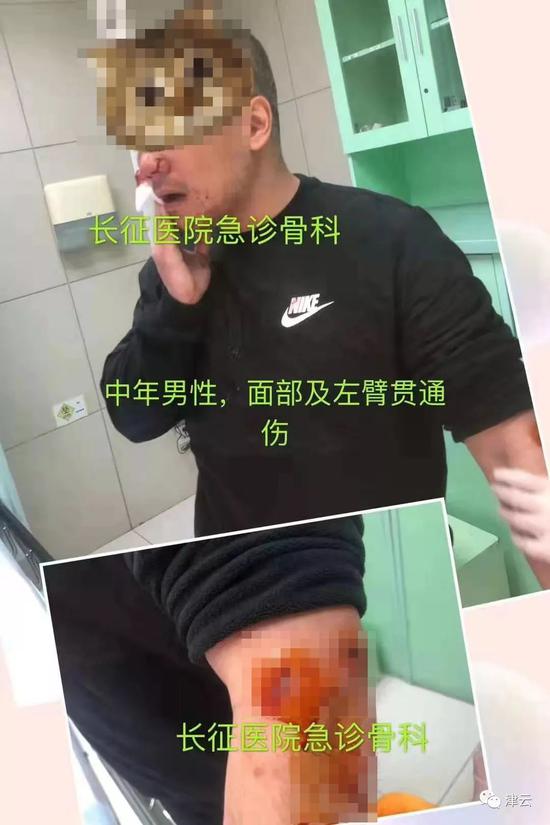  误伤男性路人的受伤情况