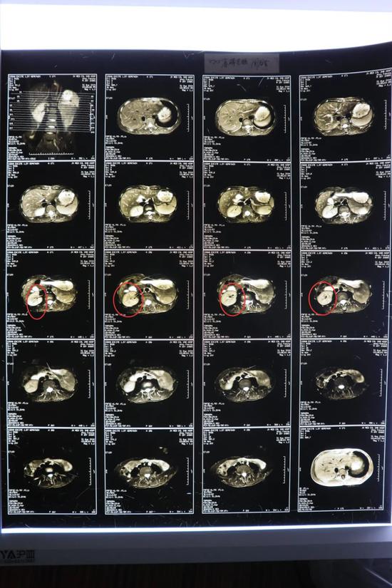 2004年8月31日江西二附医院mri片显示:右肾代偿性增大,左肾缺如