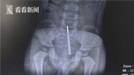 1岁半男孩测体温不配合一屁股将体温计坐入直肠