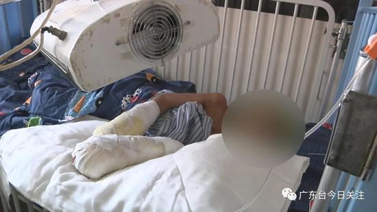 7岁男童满身烟头烫伤疤双手面临截肢 疑凶是亲生