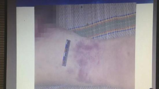 男子家中按摩猝死，家属索赔75万余元