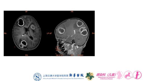 乏力,胃口不佳,后脑勺疼,好在父母及时带他去当地医院做了一次ct检查