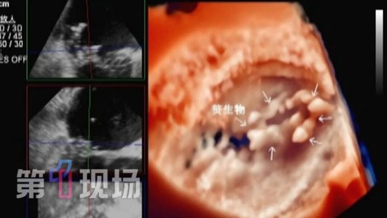 深圳51岁男子心脏长了个“马蜂窝”，每天释放细菌团，已经开始“掉渣”！医生：病根来自口腔