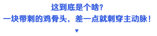 疫情期间咳成狗，她竟“咳”出了10年前的鸡骨头