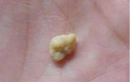 疫情期间咳成狗，她竟“咳”出了10年前的鸡骨头