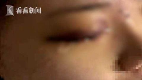 眼睛失明:19岁女孩爱美打了玻尿酸 一针下去眼睛失明(图)