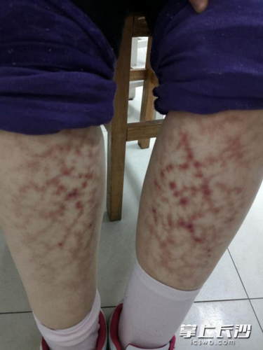 春节期间女子双腿长满网状红斑与这个习惯有关 手机新浪网