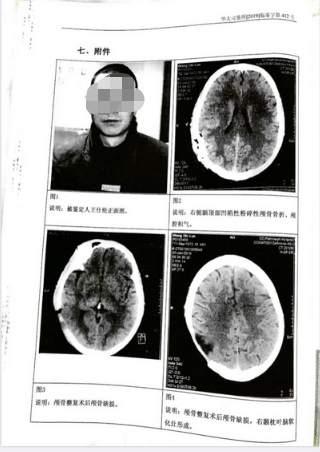 男子打麻将被砖头砸成十级伤残 他向10人索赔2