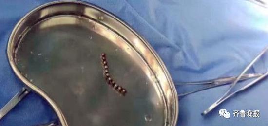 3岁男童肚子疼打针都无效 医生拍片发现异物(图