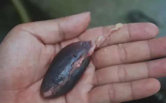 男子一颗鱼胆下肚险丢命多器官严重衰竭
