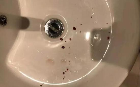 白先生说,摔倒后鼻子就流了鼻血