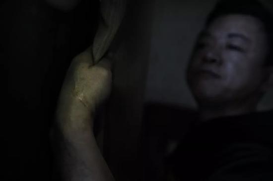 ▲2019年3月8日，吉林长春，张金宝手腕处的一处疤痕。养父意外身死后，养母经常毒打他。至今头上、身上还有许多明显的疤痕，现在谈到小时候被养母毒打，还会发抖。新京报记者 尹亚飞 摄