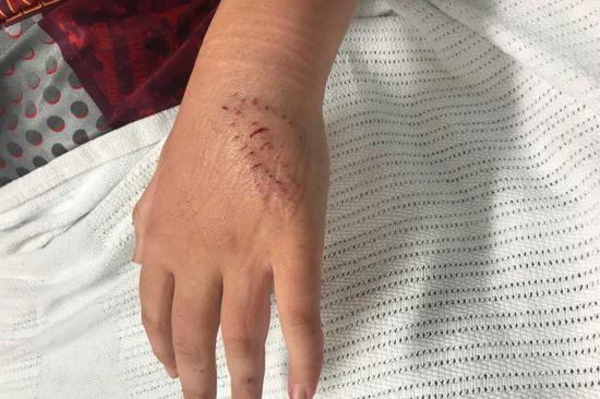 赖安的父母对他的手进行了包扎.(图片:abc)