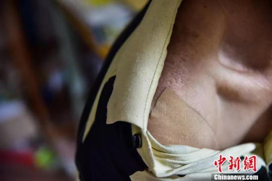 肩挑重物，周宏军肩膀也受到劳损。